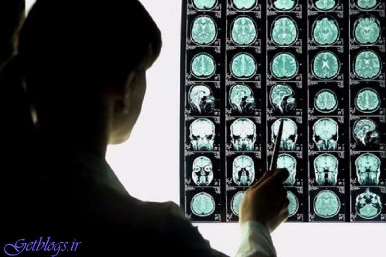 تشخیص زودهنگام آلزایمر امکان پذیر شد